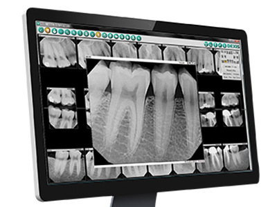 Dexis Digital X-Rays